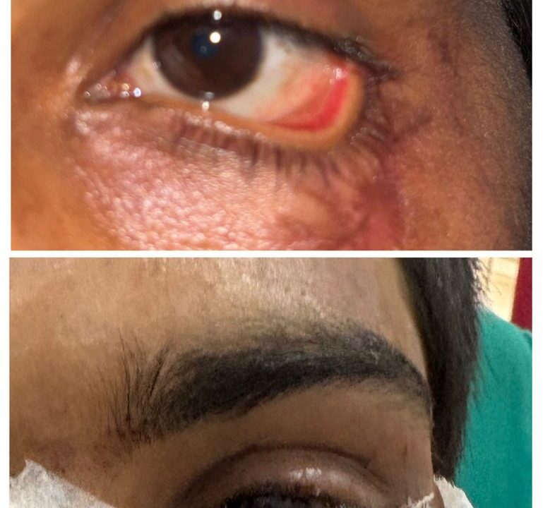 स्किन ग्राफ्टिंग से मरीज के पलक का सफल पुनर्निर्माण,,,,,